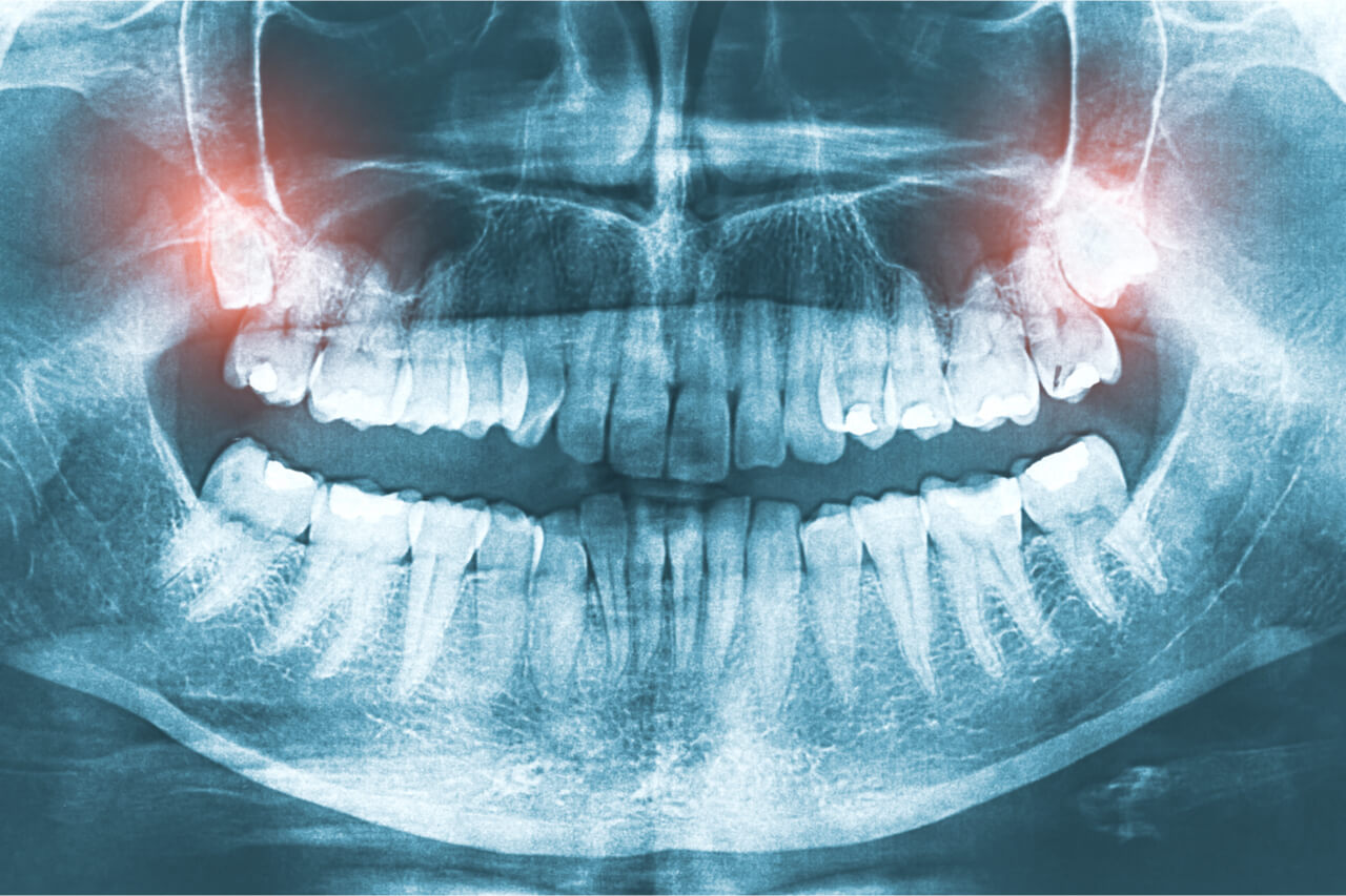 Can You Get Nerve Damage from Wisdom Tooth Extraction?